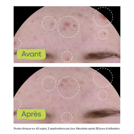 Soin Visage Peaux à Tendance Acnéique Matifiant Anti-Imperfections Biology Ac Global Bio A-DERMA