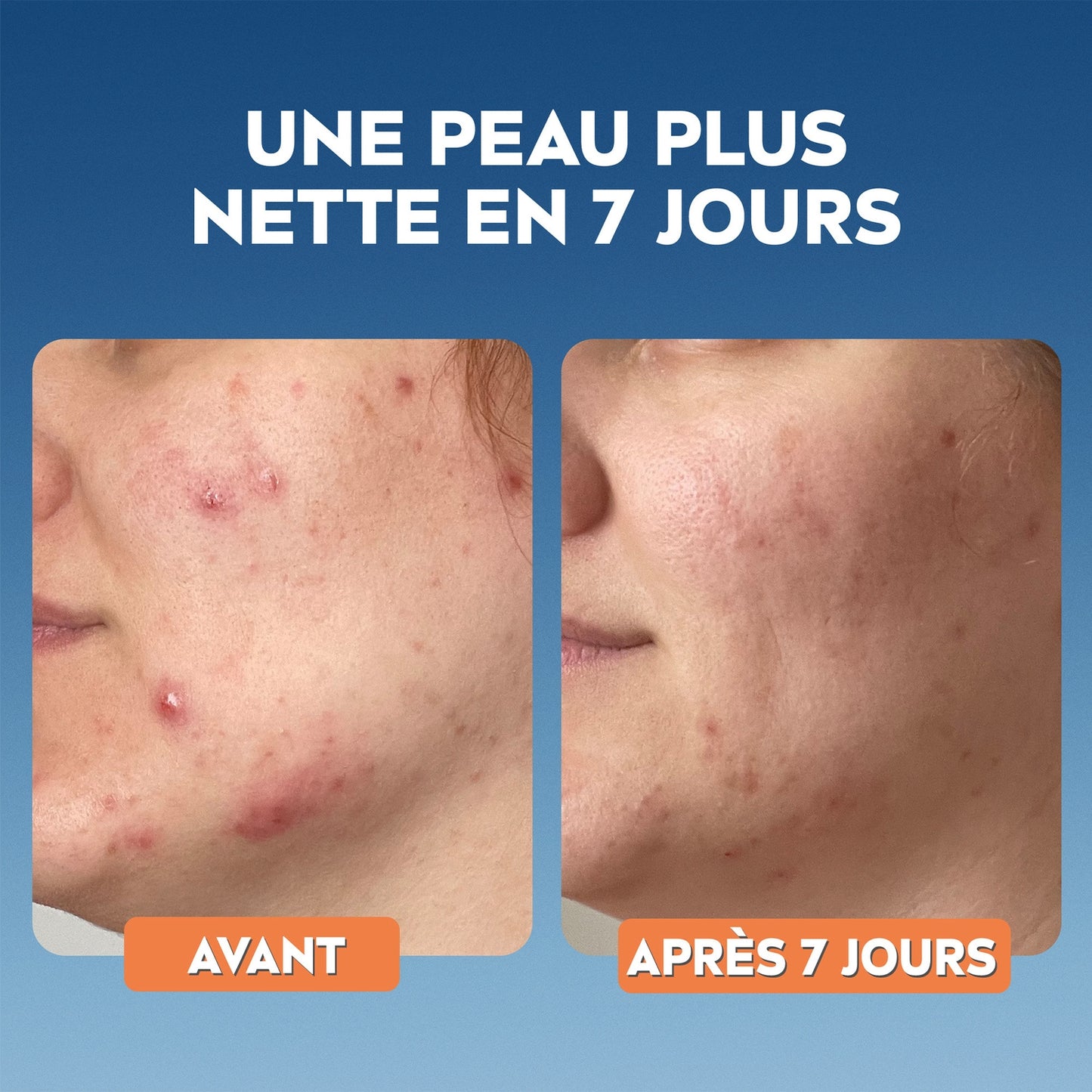 NIVEA Derma Skin Clear Gesichtsbehandlung mit Hyaluronsäure, Provitamin B5, Niacinamid