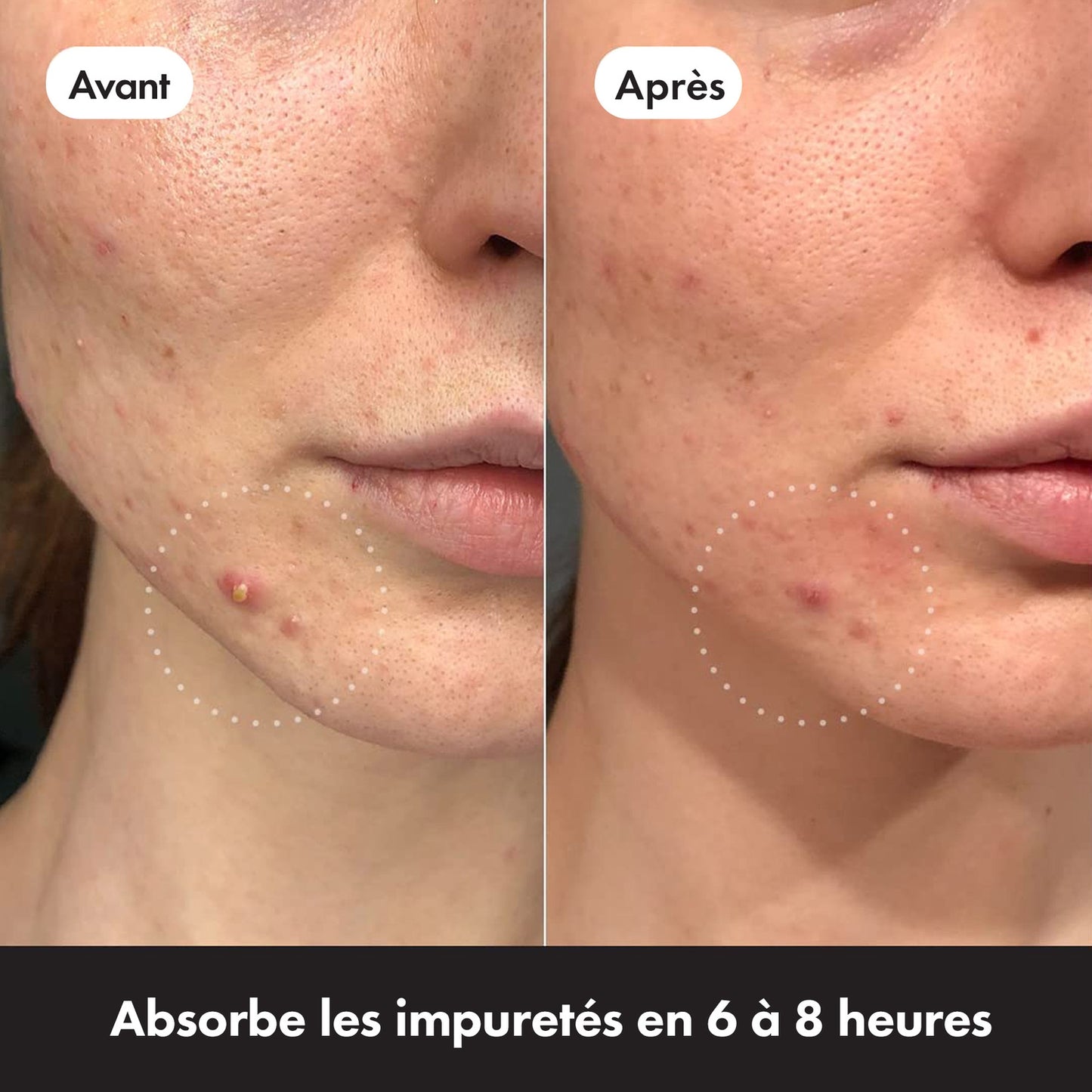 Patchs Anti-acné Jour et Nuit Invisible Hydrocolloïde pour Boutons HERO 